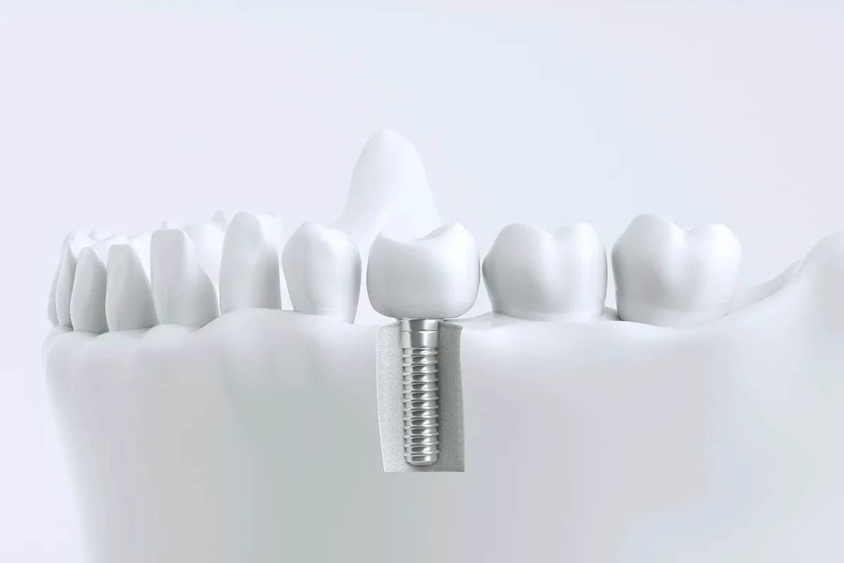 Illustration of a dental implant with a crown
